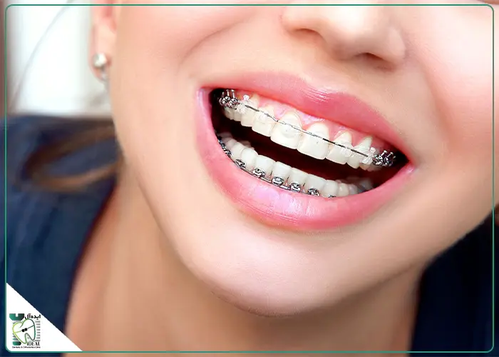 ارتودنسی ثابت سرامیکی