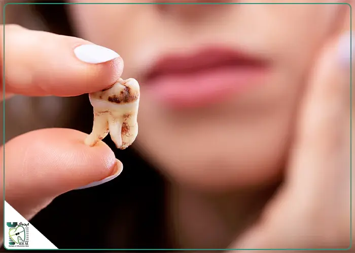 علائم پیشرفته پوسیدگی دندان