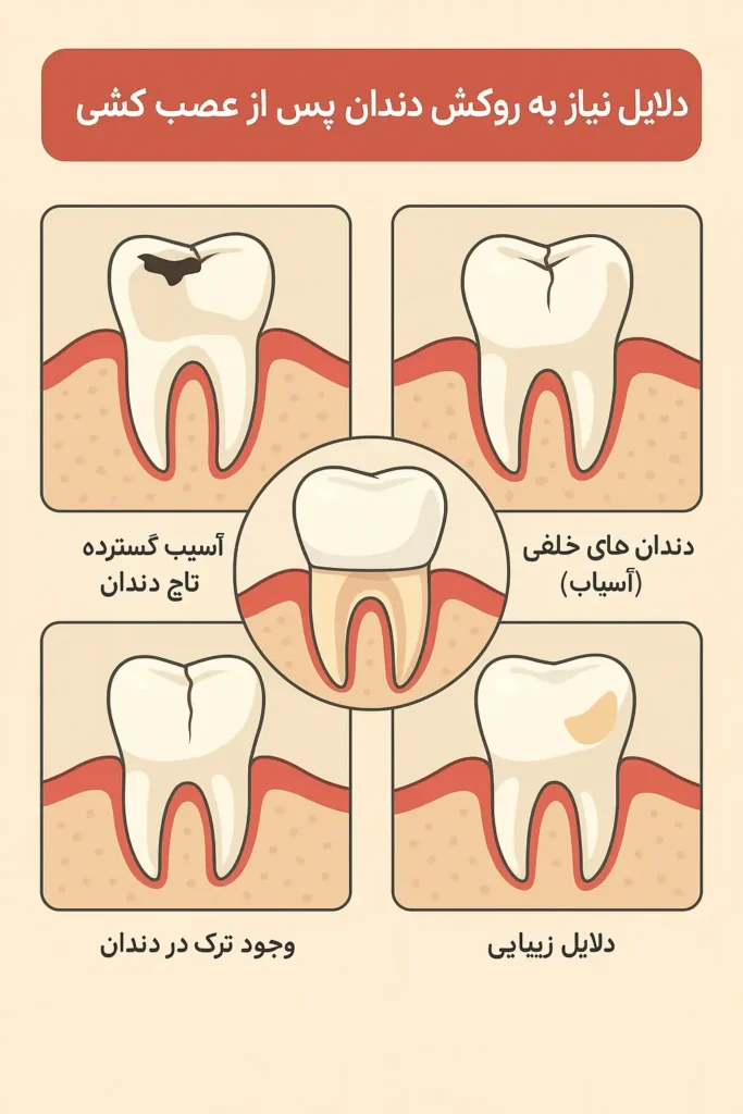 زمان روکش دندان عصب کشی شده