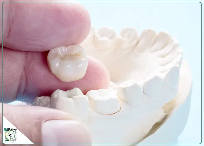 ریسک ها و خطرات انجام ندادن روکش در شرایط لزوم