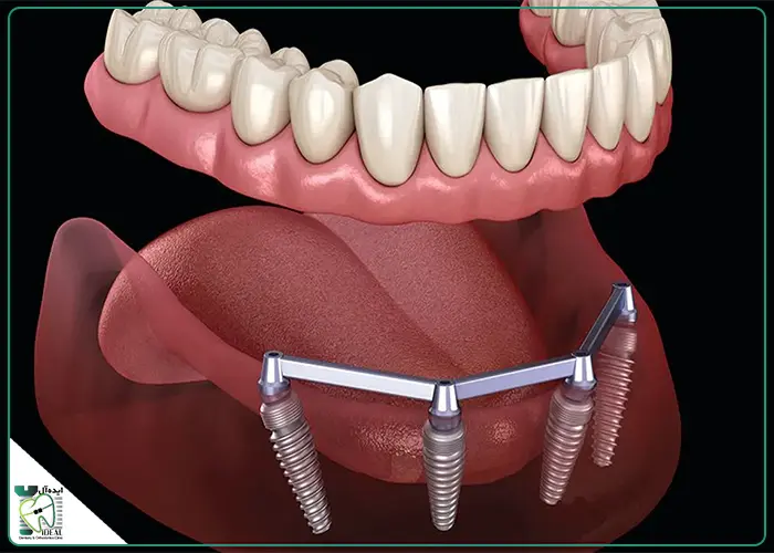 اجزای تشکیلدهنده اوردنچر