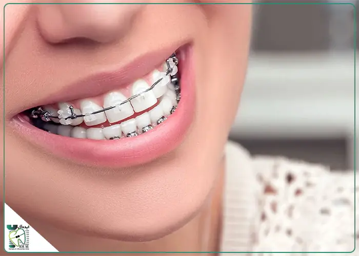 ارتودنسی با بریسهای سرامیکی در MRI