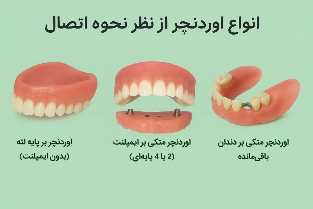 انواع اوردنچر از نظر نحوه اتصال