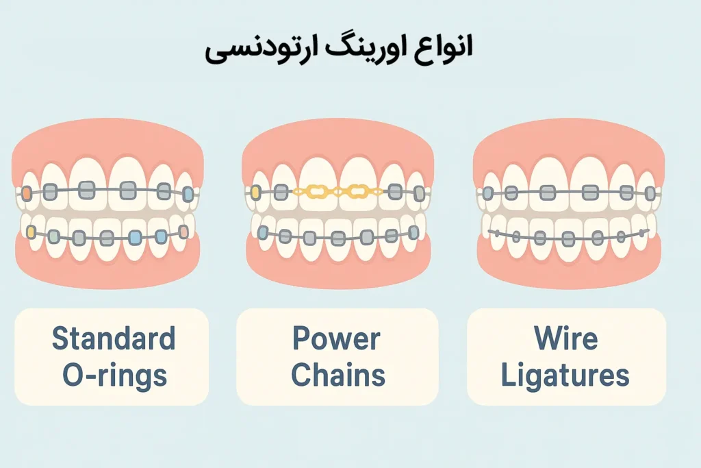 انواع اورینگهای ارتودنسی