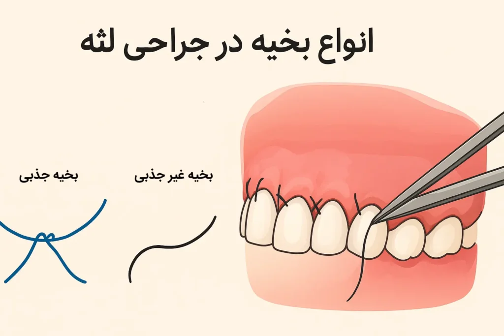 انواع بخیه در جراحی لثه