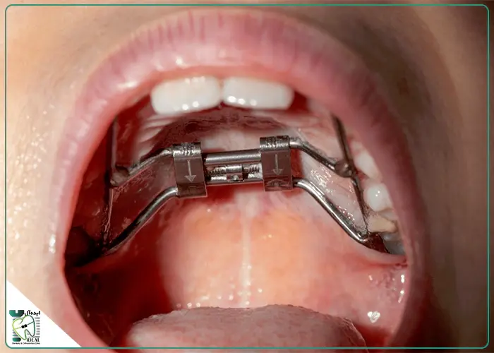 وسیع کننده کام (Palatal Expander) دقیقا چیست؟