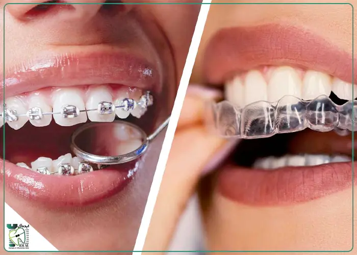 مقایسه با ارتودنسی ثابت فلزی