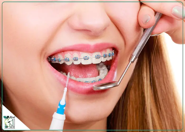 ارتودنسی مجدد چیست؟