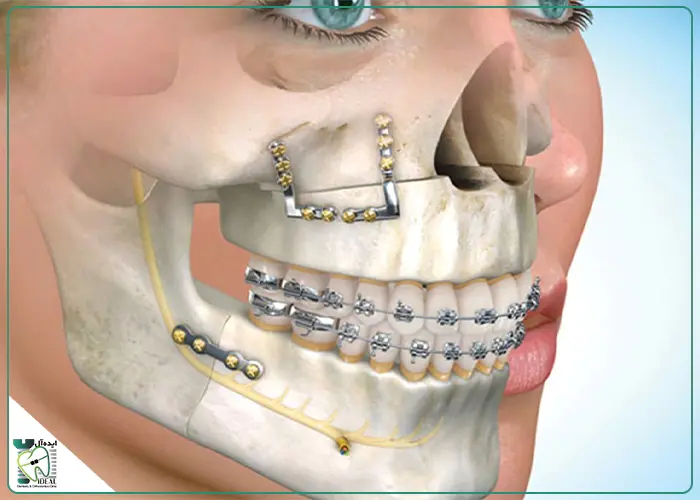 ارتوسرجری چیست؟ راهنمای جامع و کاربردی