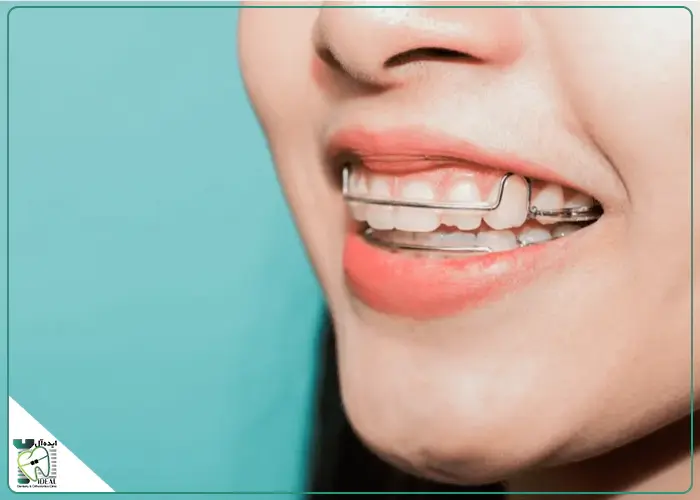 چه کسانی به بایت پلیت ارتودنسی نیاز دارند؟