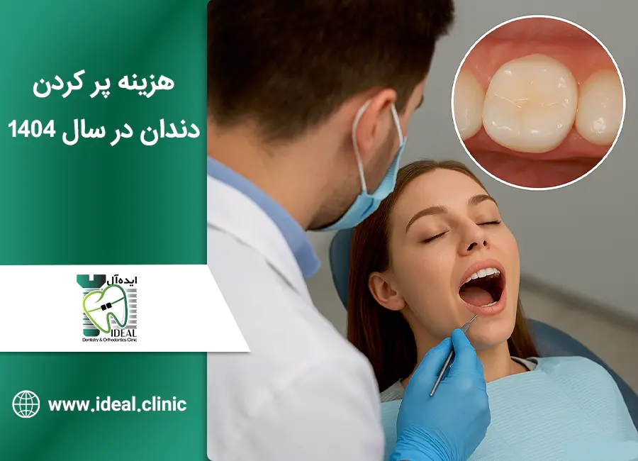 هزینه پر کردن دندان در سال 1404