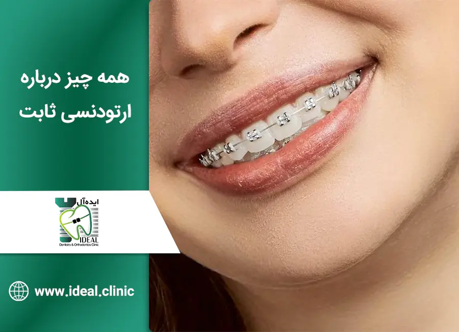 همه چیز درباره ارتودنسی ثابت