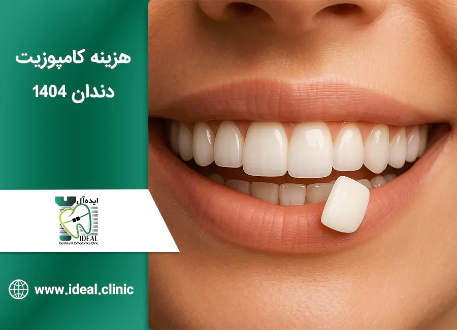 هزینه کامپوزیت دندان در تهران 1404