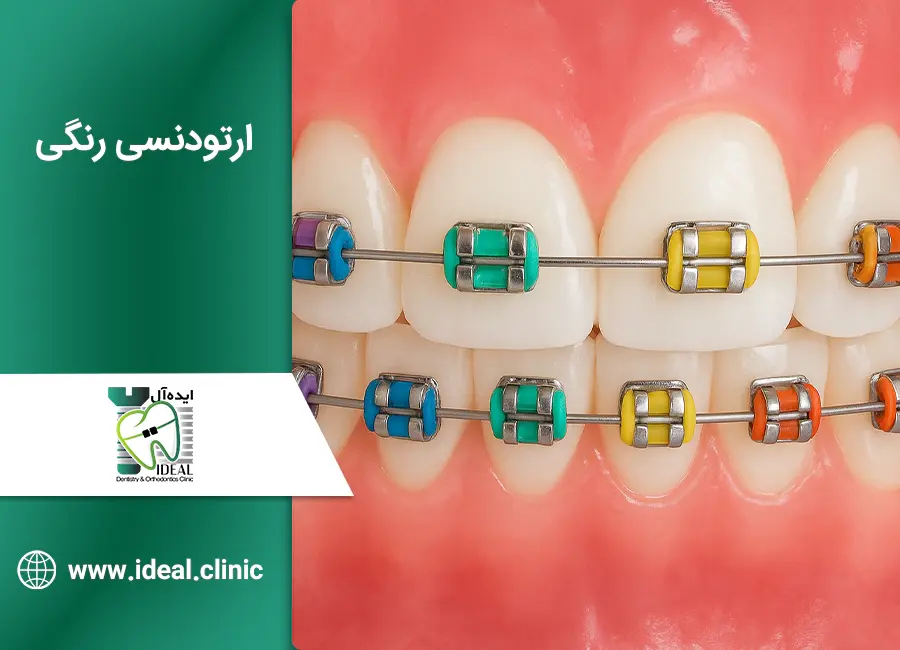ارتودنسی رنگی: راهنمای جامع