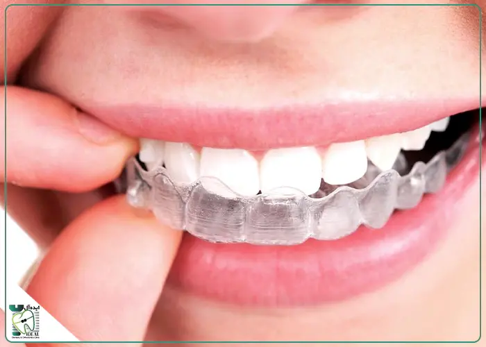 الاینر شفاف (Invisalign)