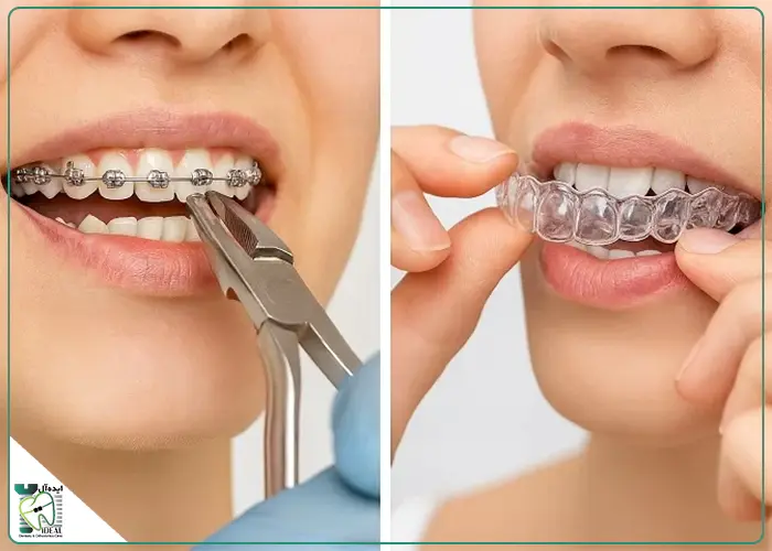 مقایسه ارتودنسی ثابت و متحرک