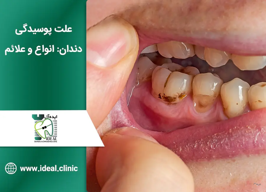 علت پوسیدگی دندان: انواع و علائم