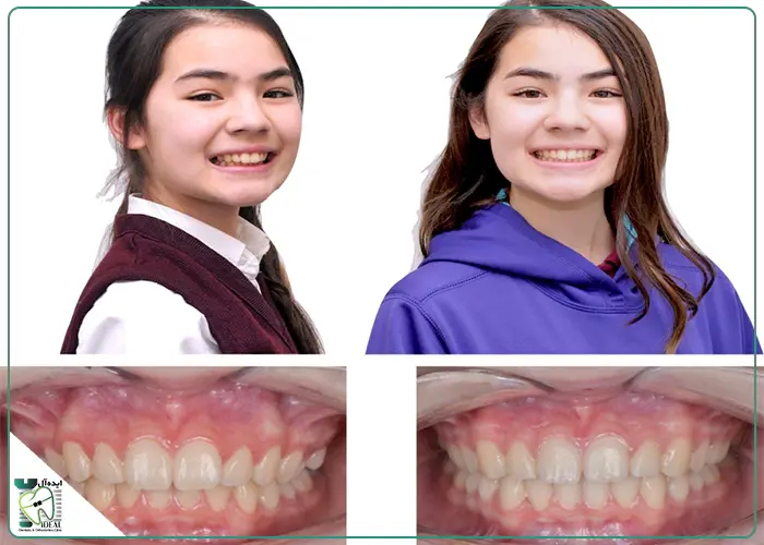 عکس قبل و بعد ارتودنسی