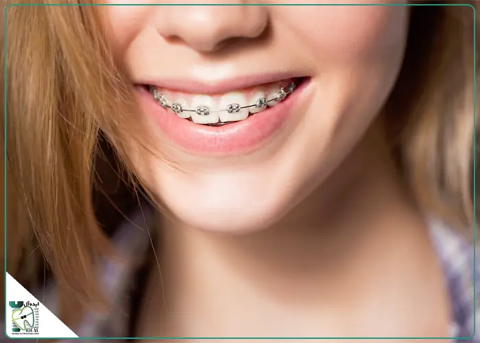 اصلاح بایت با ارتودنسی