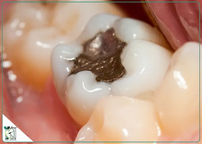 موارد تجویز بالینی آمالگام