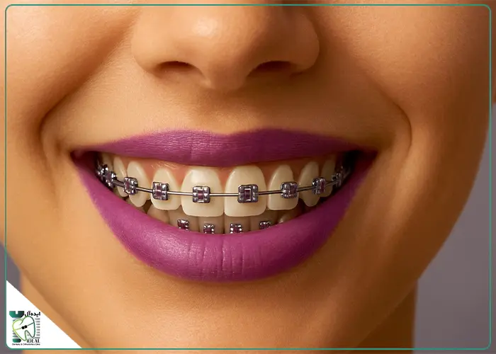 رنگ ارتودنسی بنفش