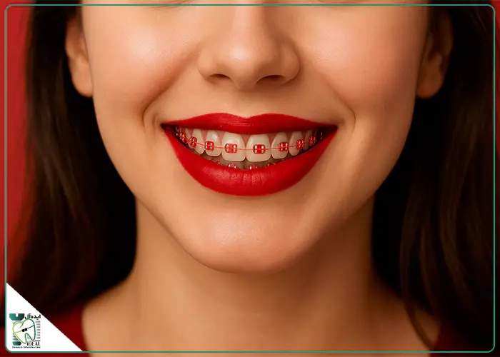 رنگ ارتودنسی قرمز