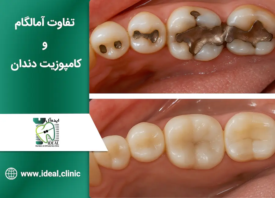 مقایسه کامپوزیت و آمالگام: بررسی ۷ تفاوت کلیدی