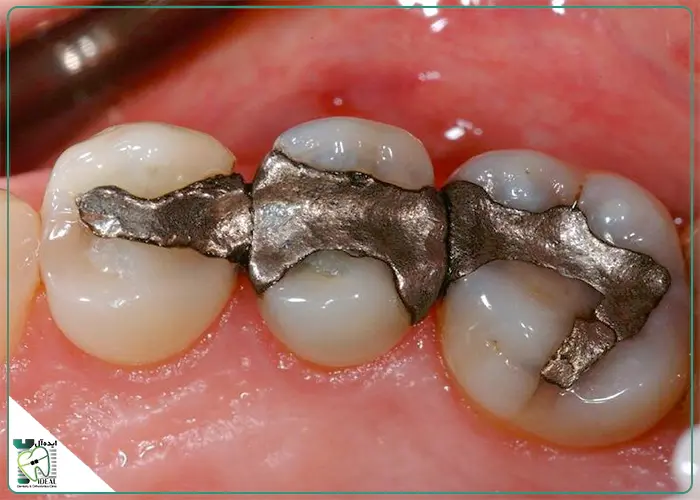تحلیل هزینه-فایده استفاده از آمالگام