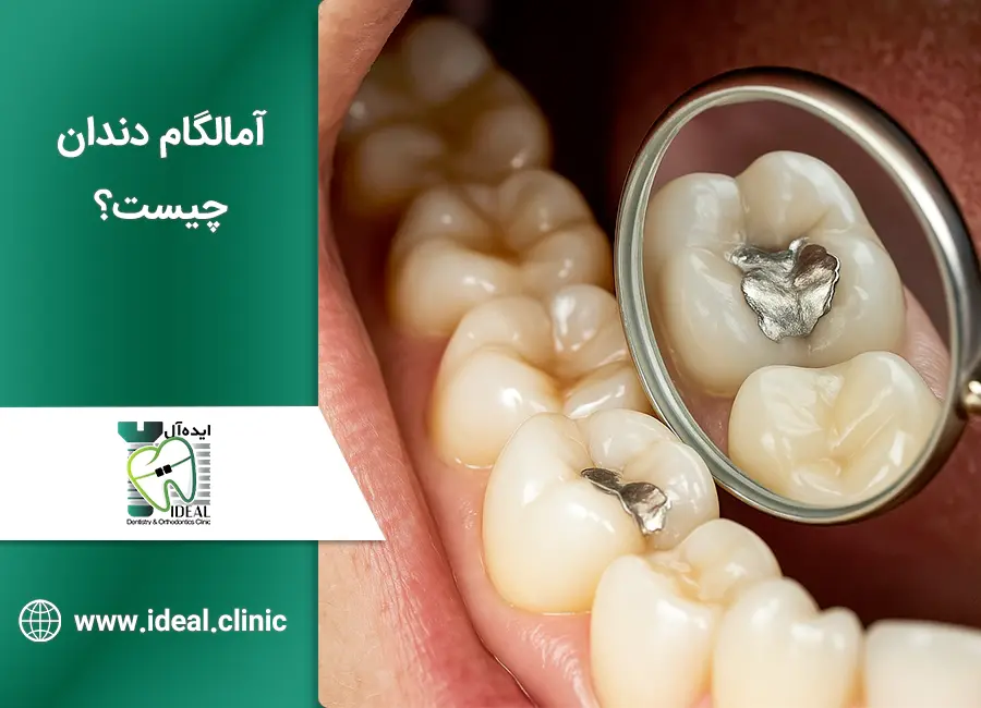 آمالگام دندان چیست