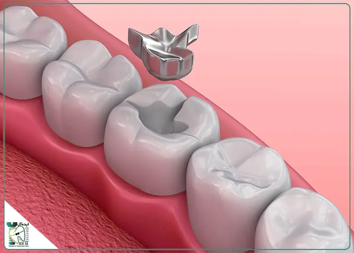 آمالگام چیست؟