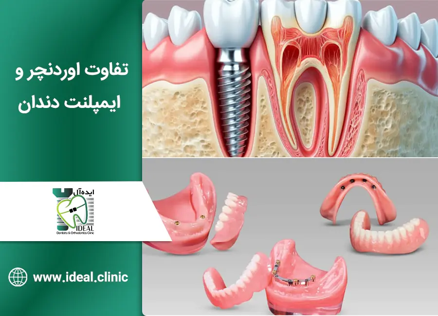 تفاوت اوردنچر و ایمپلنت دندان