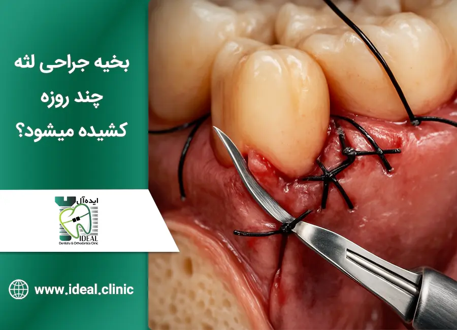 بخیه جراحی لثه چند روزه کشیده میشود
