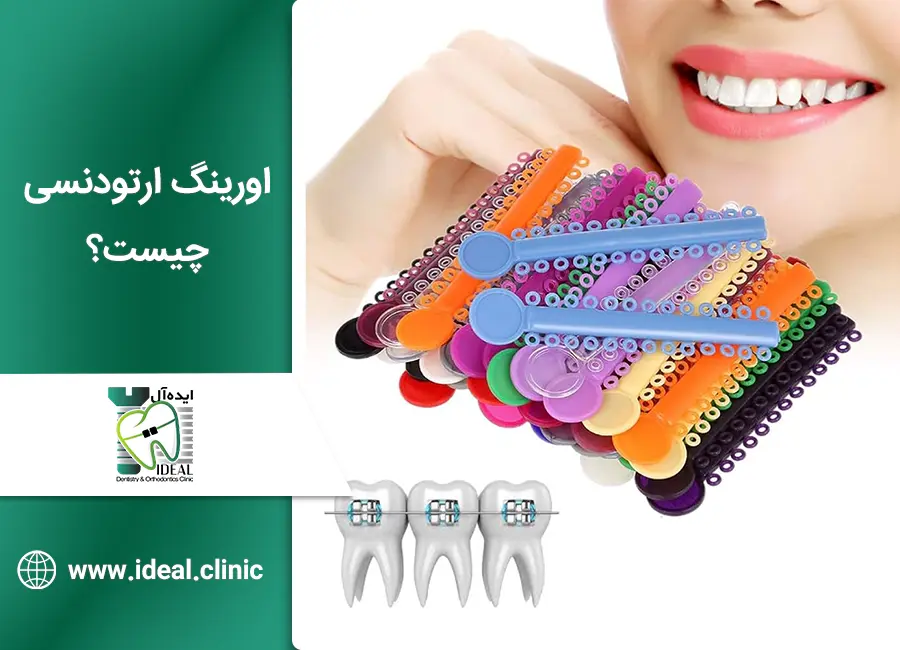 اورینگ ارتودنسی چیست؟