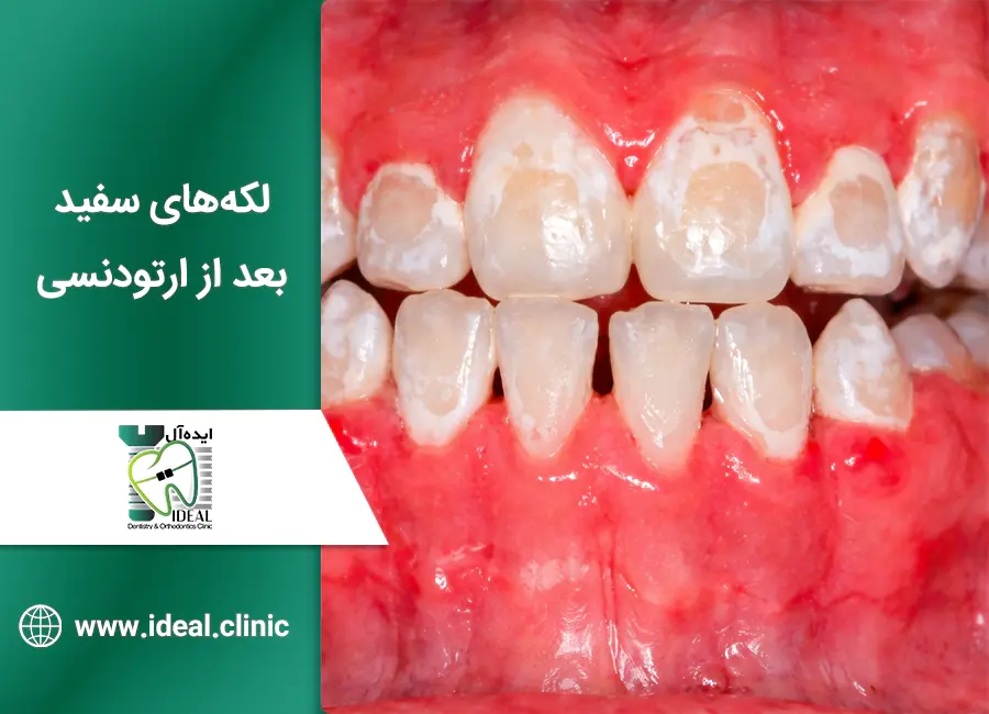 لکههای سفید روی دندان بعد از ارتودنسی