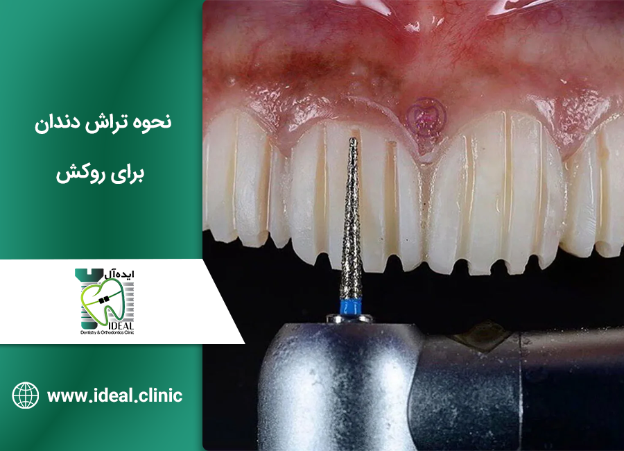 نحوه انجام تراش دندان برای روکش