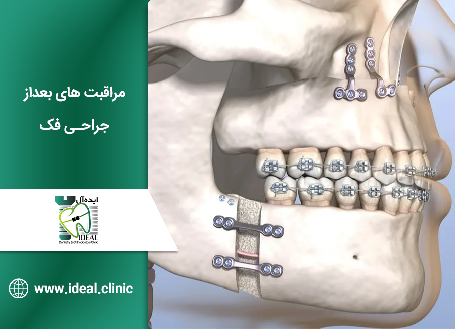 مراقبت های بعد از جراحی فک
