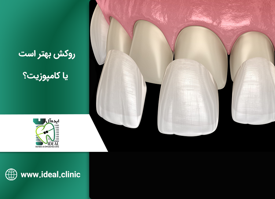 روکش بهتر است یا کامپوزیت