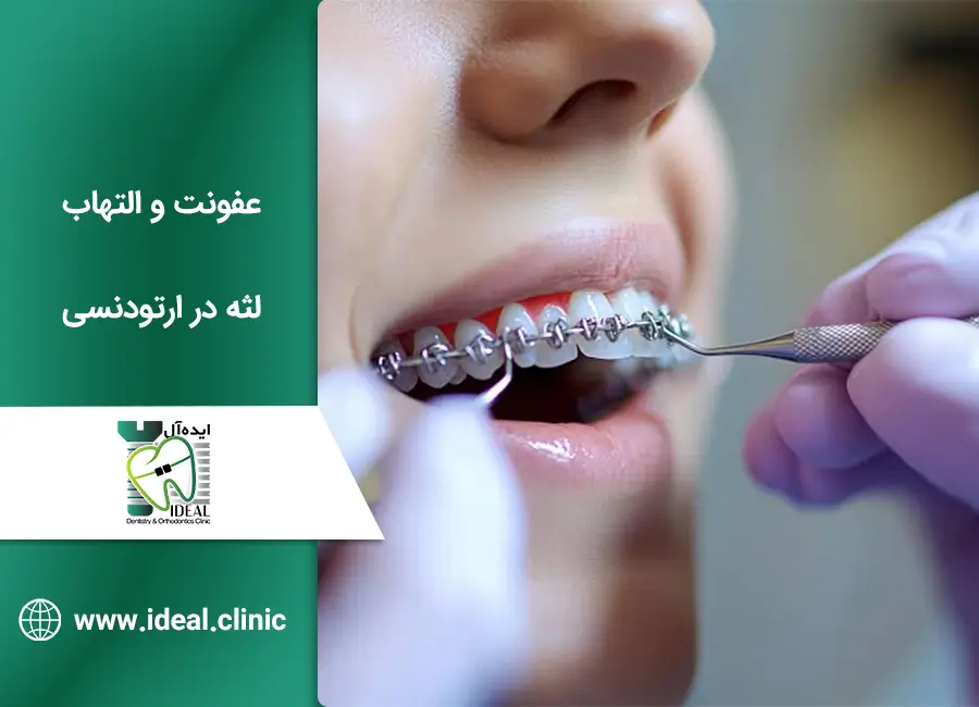 عفونت و التهاب لثه در ارتودنسی