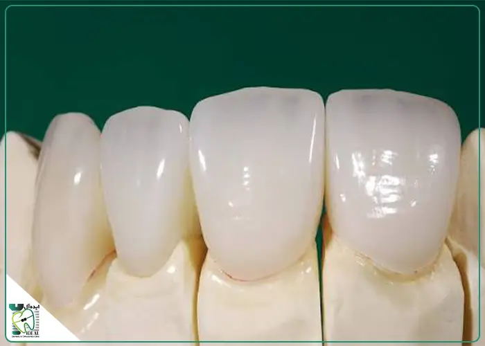 لمینت دندان آی پی اس ایمکس