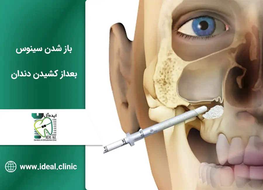 باز شدن سینوس بعداز کشیدن دندان