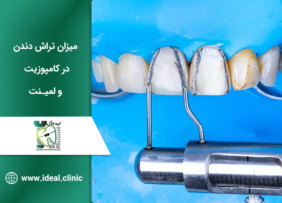 تراش دندان در کامپوزیت و لمینت