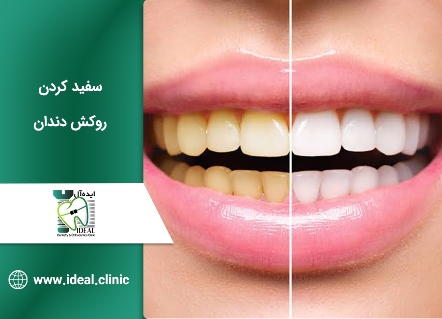 سفیدکردن روکش دندان