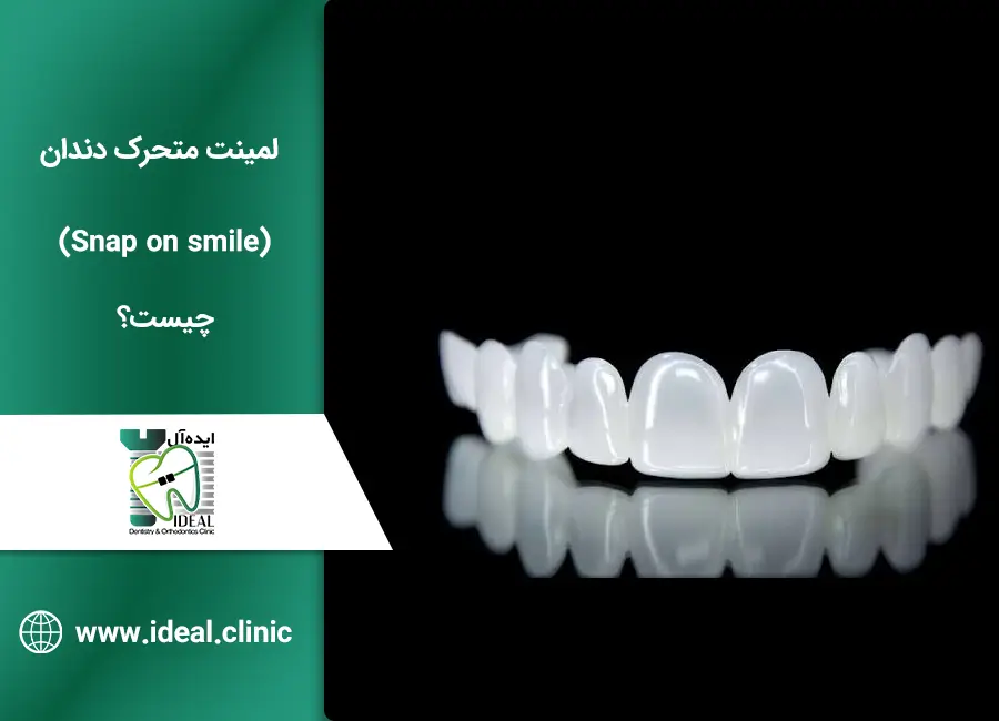 لمینت متحرک دندان