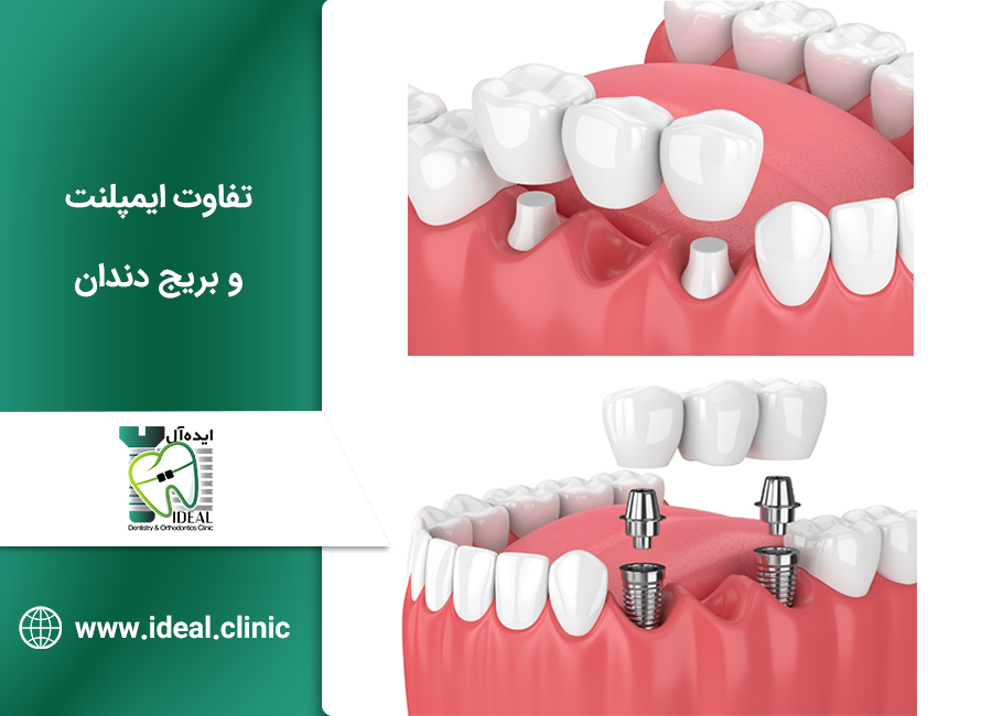 تفاوت بریج و ایمپلنت دندان