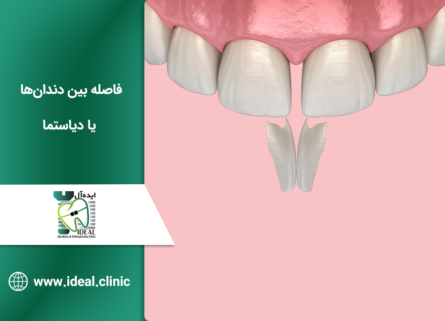 درمان فاصله بین دندان‌ها یا دیاستما