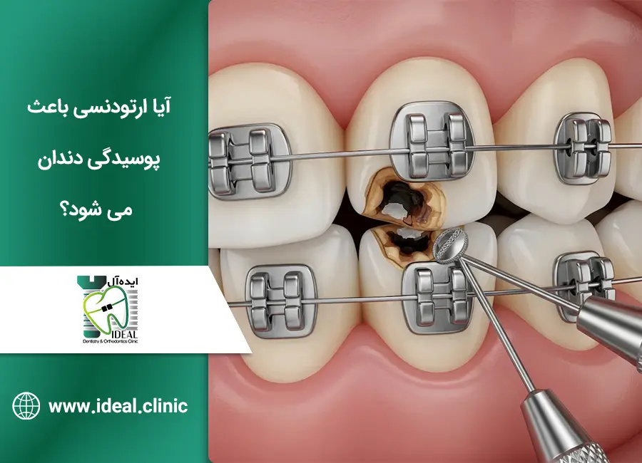 آیا ارتودنسی باعث پوسیدگی دندان می شود