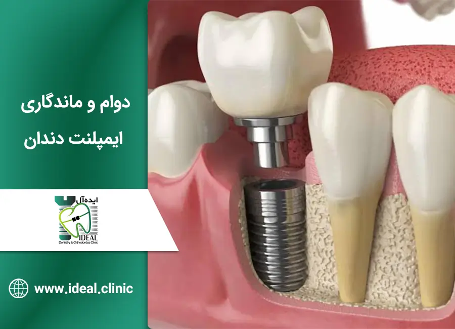 دوام و ماندگاری ایمپلنت