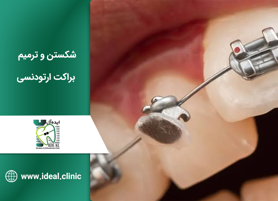 شکستن و ترمیم براکت ارتودنسی
