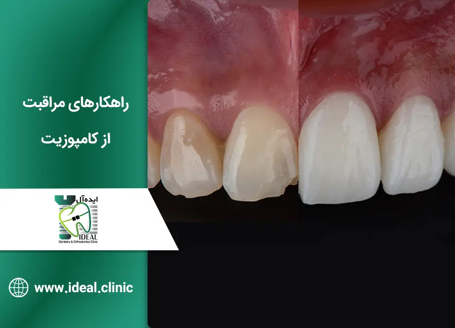 مراقبت از کامپوزیت