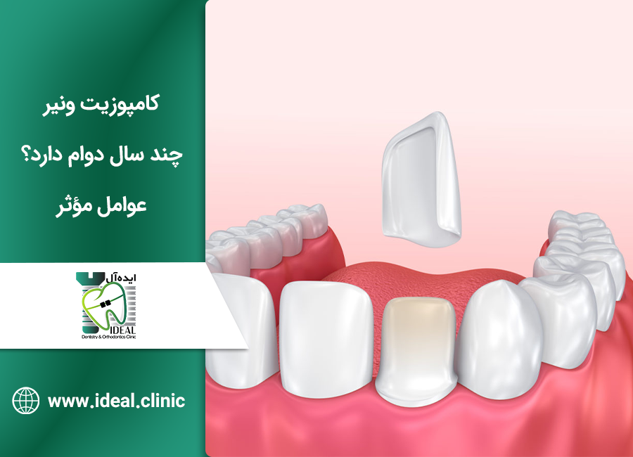 کامپوزیت ونیر چندسال دوام دارد